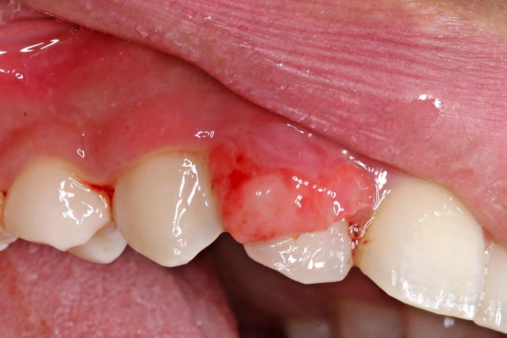 Swelling and Oral Growth